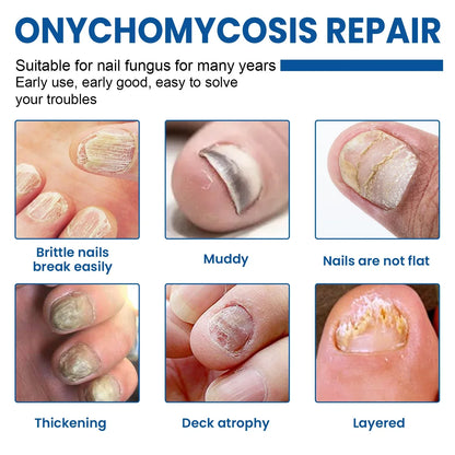 Fungus Nail Repair Patches